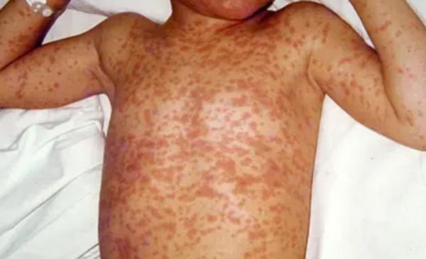 Second measles death reported in Israel amid surging cases